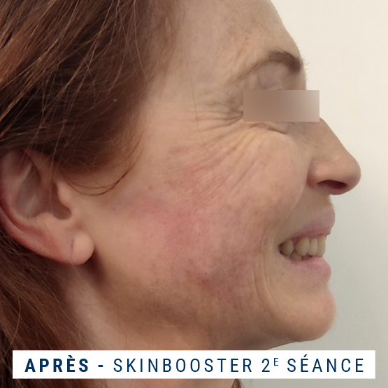 Exemple visage profil après injection SKINBOOSTER