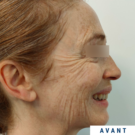 Exemple visage profil avant injection SKINBOOSTER