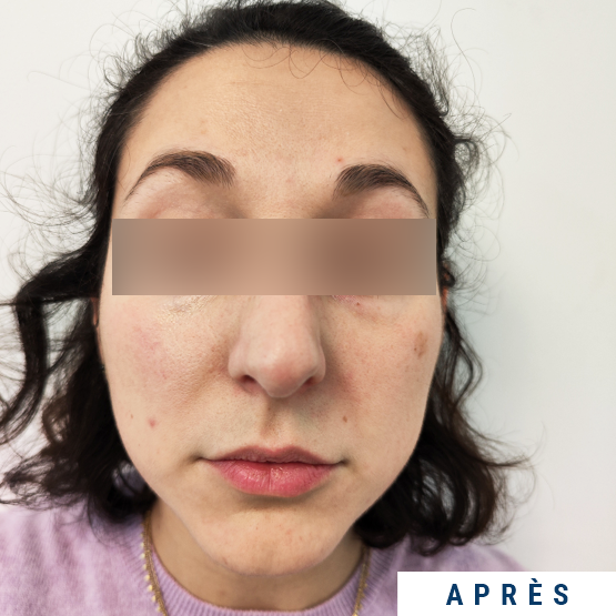 Exemple visage grain de peau et éclat après mésothérapie