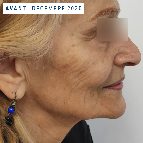 Exemple visage profil AVANT Injection acide hyaluronique tempes et pommettes