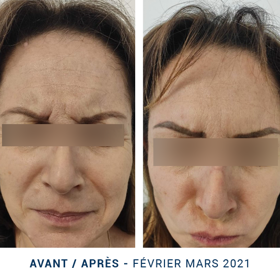 Exemple visage rides expression avant/ après Injection Botox sans picollage