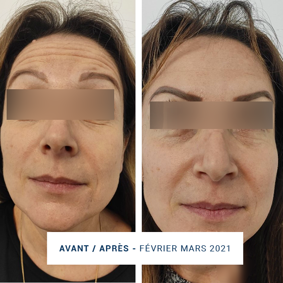 Exemple visage front avant/ après Injection Botox sans picollage