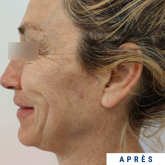 Exemple visage profil après injection SKINBOOSTER