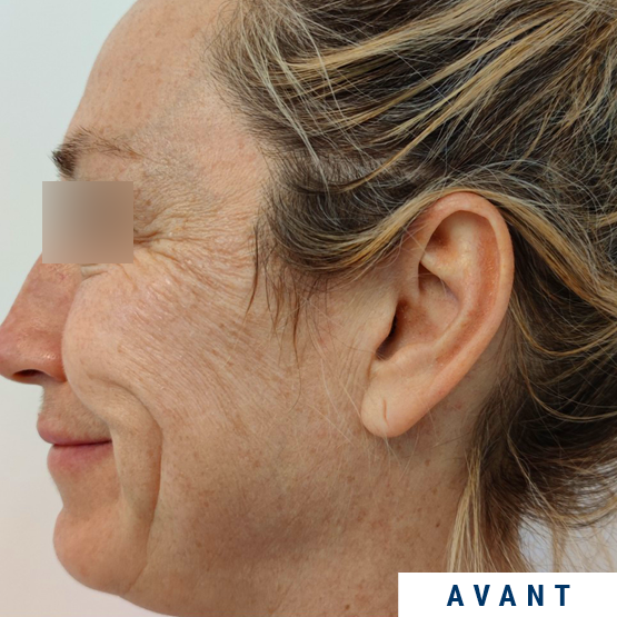 Exemple visage profil avant injection SKINBOOSTER